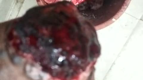 Wound of lower Limb