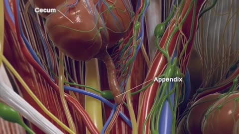 Appendix Removal Surgery😨🩺#Appendix #surgery #health #life