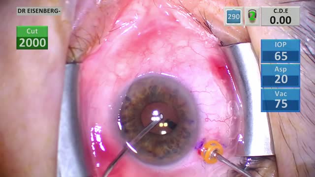 Malignant glaucoma Pars plana vitrectomy technique