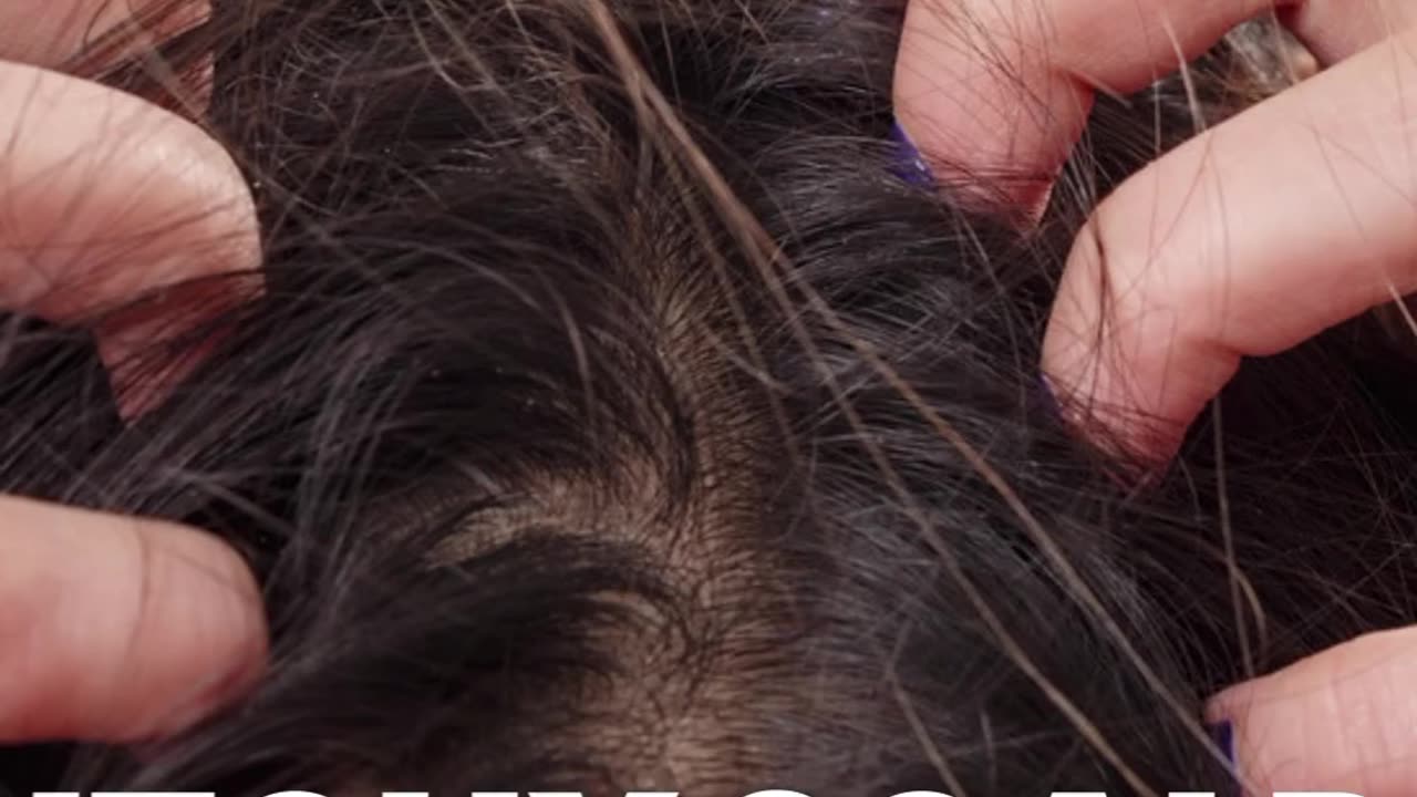 Scalp Tenderness