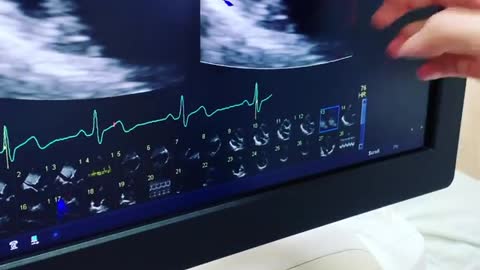 World Record Holder Diagnosed With Myopericarditis After Pfizer Vaccine