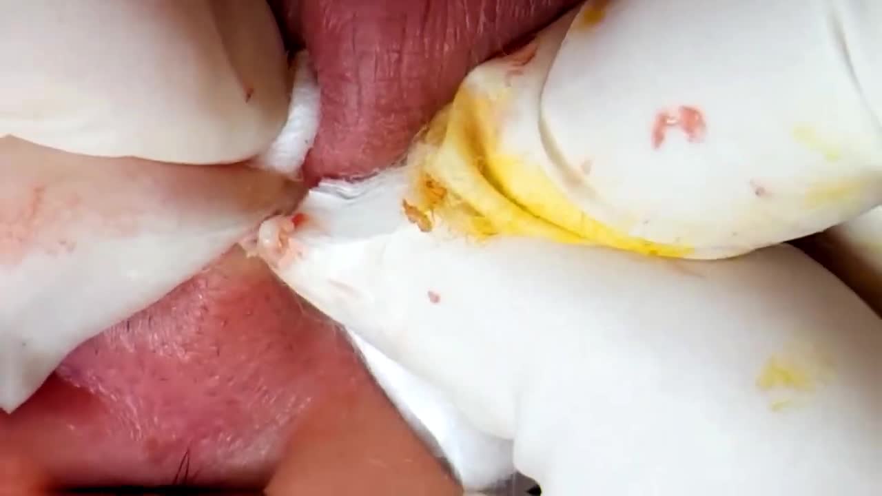 Relaxing Acne Removal Pimple Out