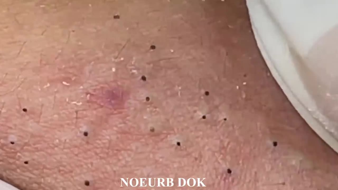 Popping tons of blackhead part3