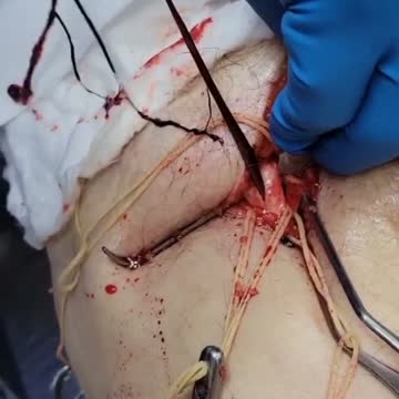 Embalmer releases footage of unbelievable blood clots from vaccinated people that died.