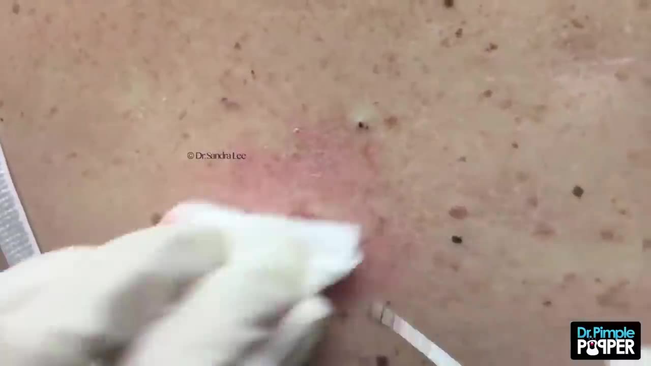 Large blackheads popping