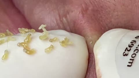 SATISFYING BLACKHEAD POPPING!!!