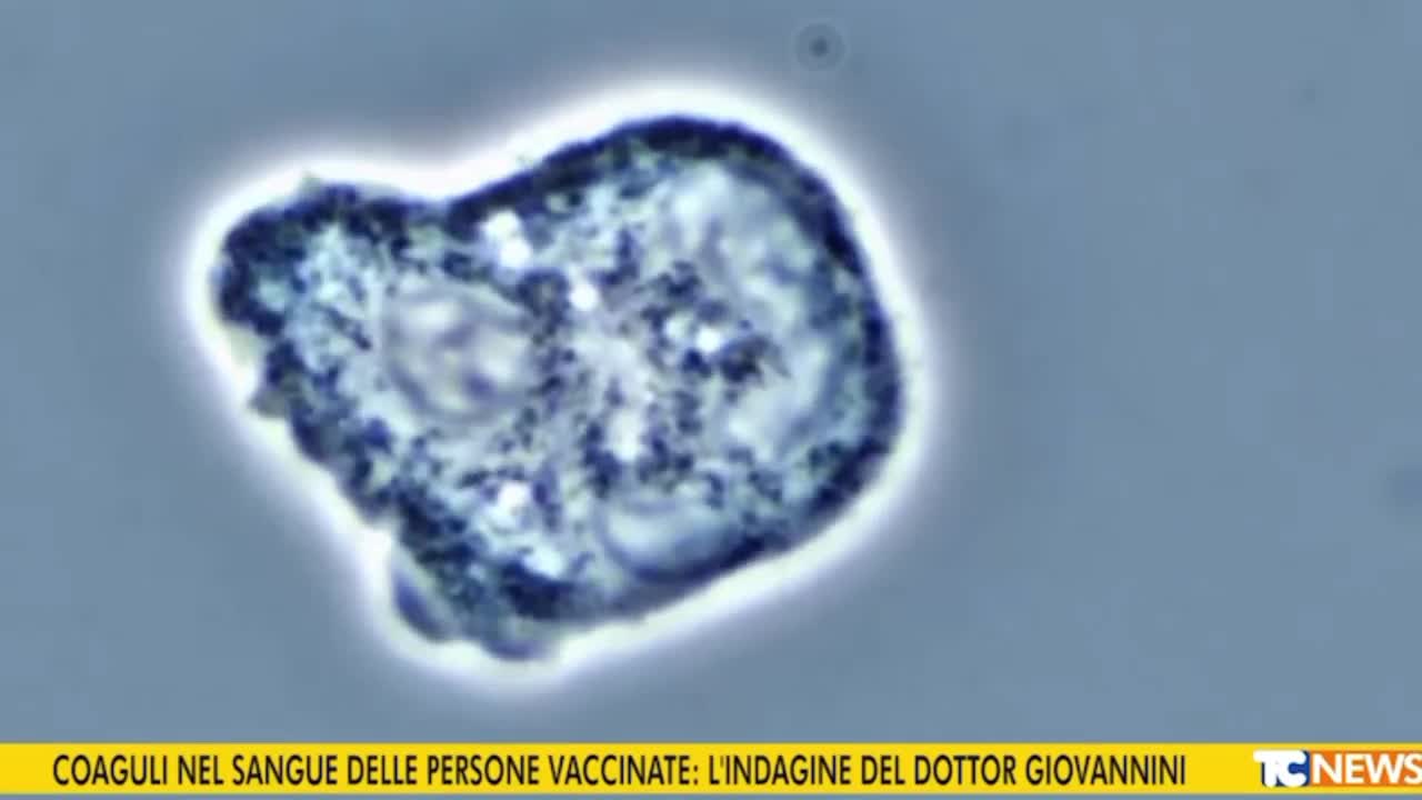 Sandro Torella - Medico rileva coaguli di sangue nell'80% dei vaccinati