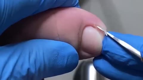 Ingrown toenail satisfying removal