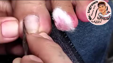 Ingrown toenail