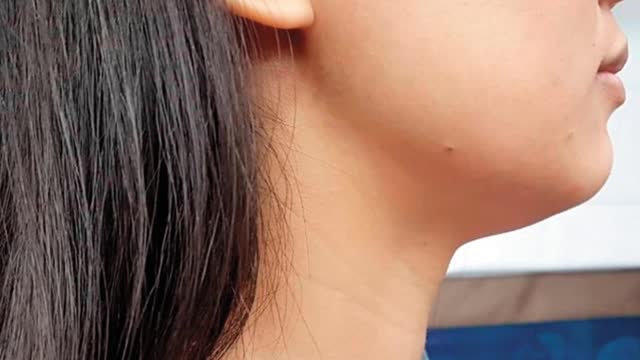 甲狀腺風暴致死率高！ 專家點名7食物勿碰
