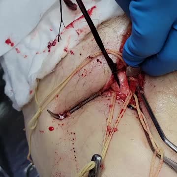 "This Is Not Normal" - Embalmer Richard Hirschman Releases Footage of Unbelievable Blood Clots