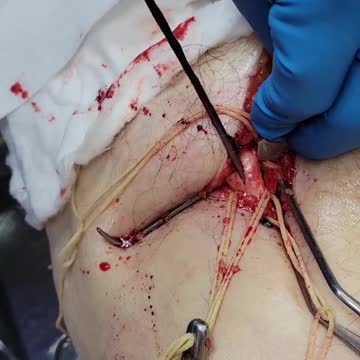 [VAX GENOCIDE] Have a nice blood clot aka 'vaccine'