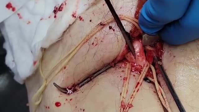 [VAX GENOCIDE] Have a nice blood clot aka 'vaccine'