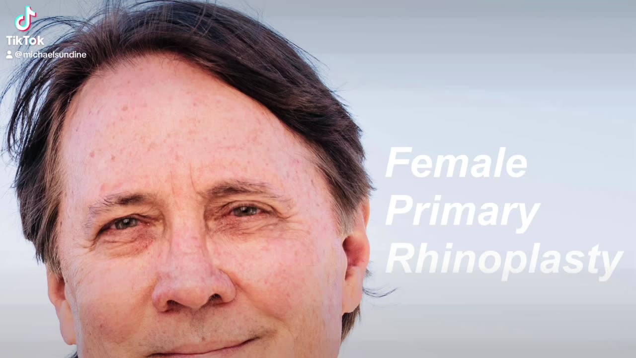 More female primary rhinoplasty