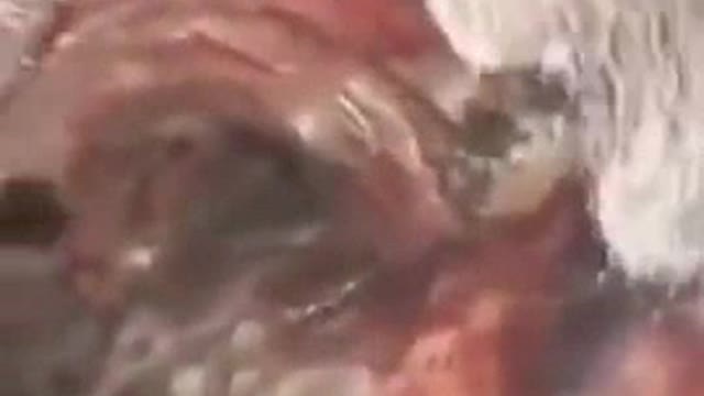 GRAPHENE OXIDE IN THE LUNGS & ESOPHAGUS OF A VAXXED PATIENT