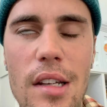 Justin Beiber Facial Paralysis vaccine side effect