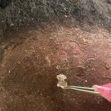 Serious Dandruff Infection