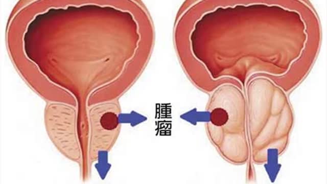 男性解尿滴到鞋 攝護腺作怪