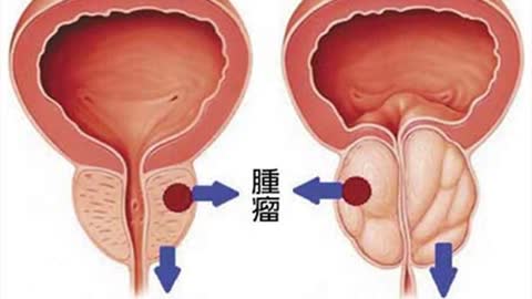 男性解尿滴到鞋 攝護腺作怪