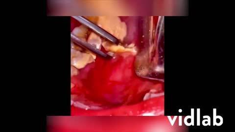 Tooth tartar removal extreme