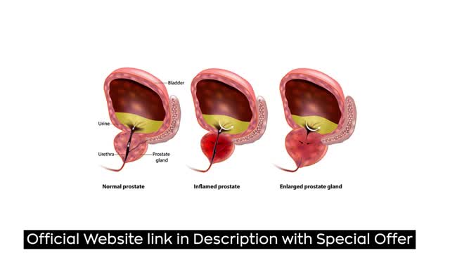 Prostate Problems:1 in 4 Men Who Lack Prostate Nutrient Risk Total kidney