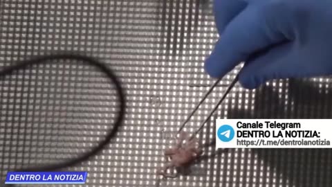 Effetti collaterali gravissimi di un infermiera sottoposta a vaccinazione obbligatoria covid 19