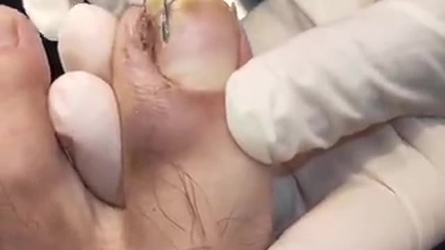 Ingrown Toenail Removal!! I couldn't watch the whole thing D: