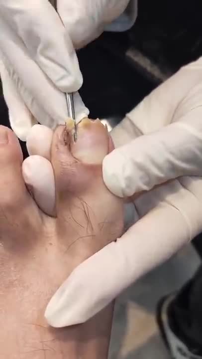 Ingrown Toenail Removal!! I couldn't watch the whole thing D: