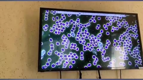 Blood after ozone drops. Make your own Ozone Water for best results.