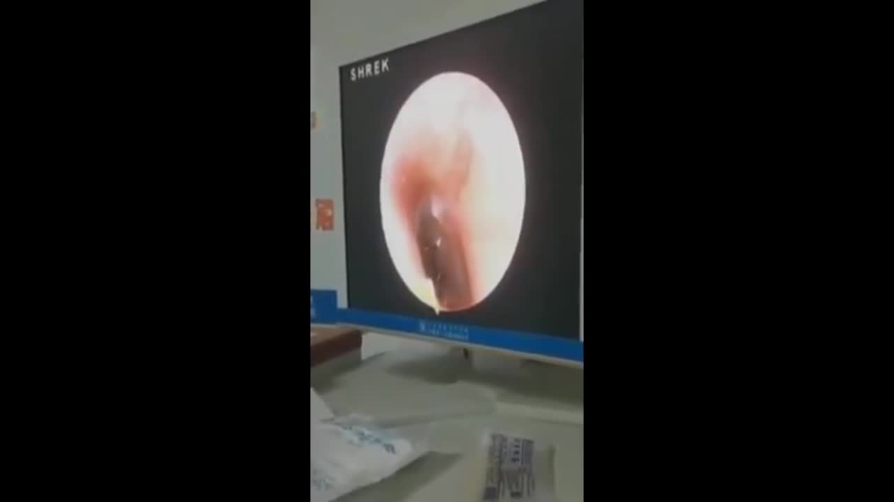 Doc Finds Spider In Teenage Boys Itchy Ear