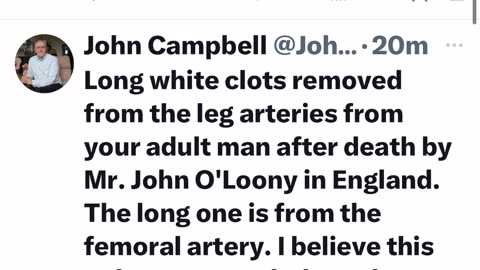 John Campbell Clots