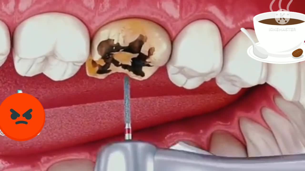 Orthopaedic treatment of excessive lip 💋