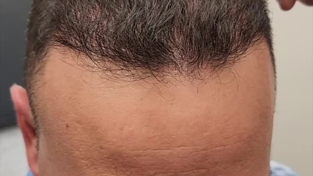 Amazing Before and After Hair Transplant Results!