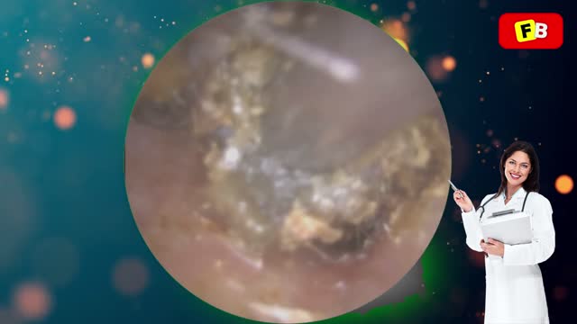 Ear Wax Removal PART 27