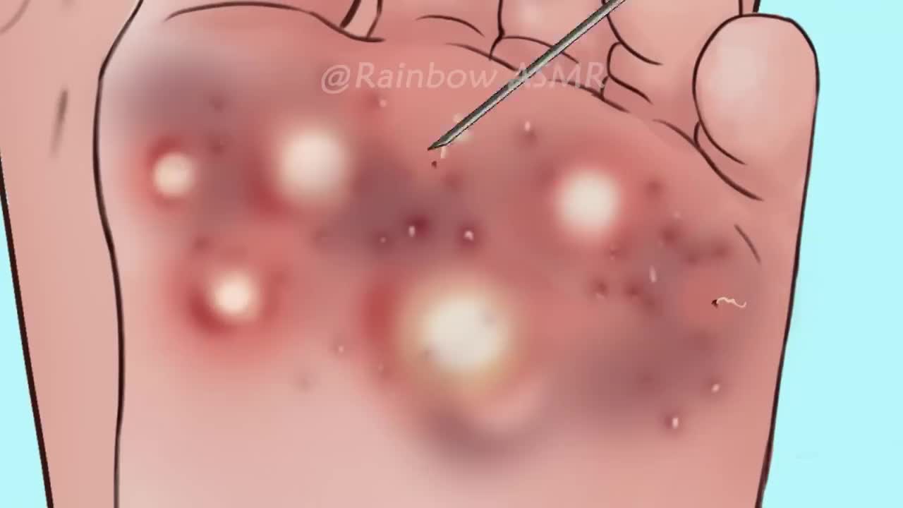 ASMR wart removal and foot cleaning