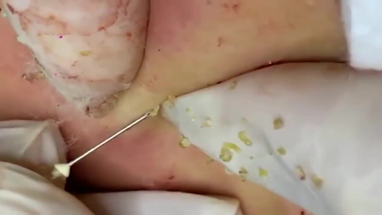 Extreme blackhead removal oddly satisfying video Episode # 1