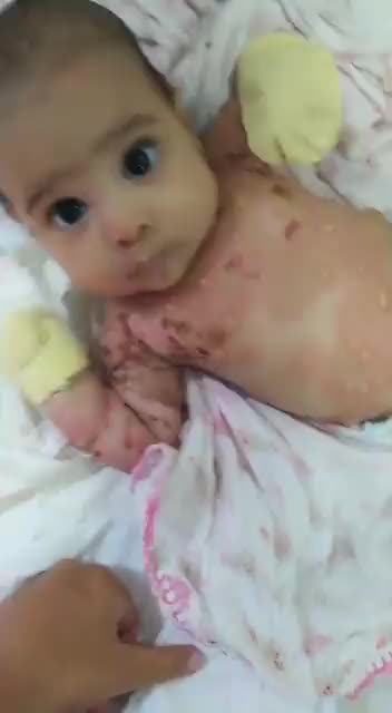 One Month Old Baby Of Vaccinated Mother