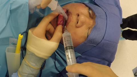 Ultrasound Guided, VASER Assisted Silicone Suction From Buttock & From Upper and Lower Lips