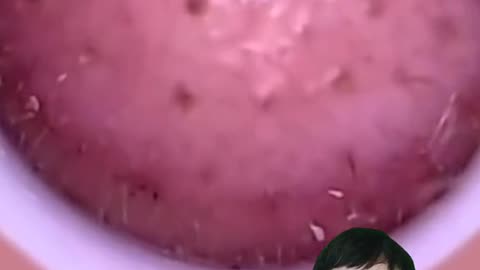 REACTION VIDEO - see blackheads up close😱