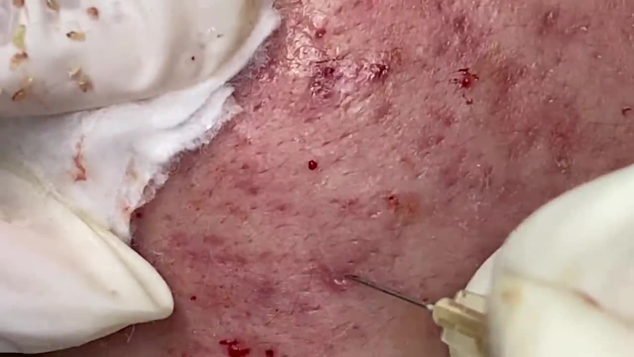 Cystic Acne Blackheads Extraction