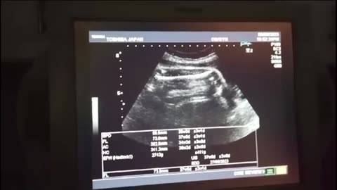 Female Gender At 38 Week With Normal Scar Thickness And No Labor Pain🫡🫡