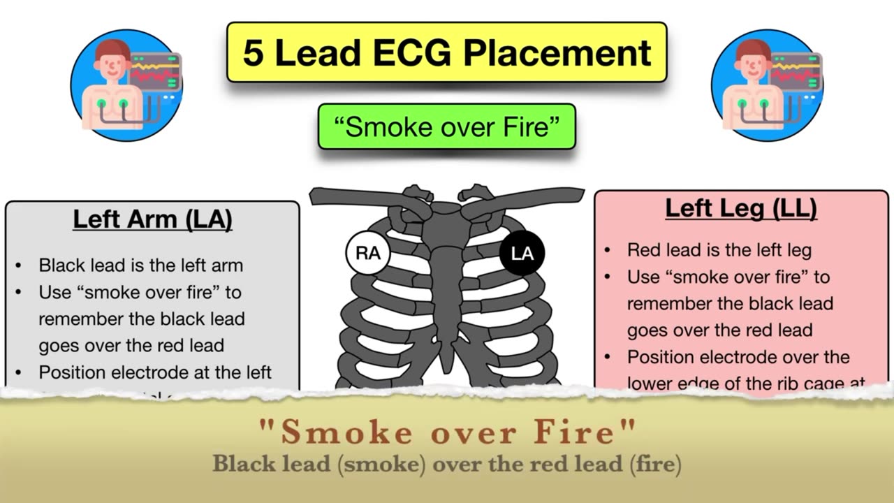 How to Place a 5 Lead ECG_ MNEMONIC [Electrode Placement Made Easy] #nursing