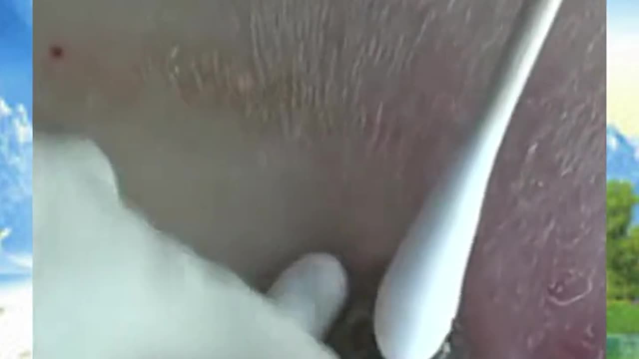 Black head removal