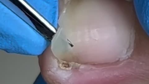 Toenail Removal