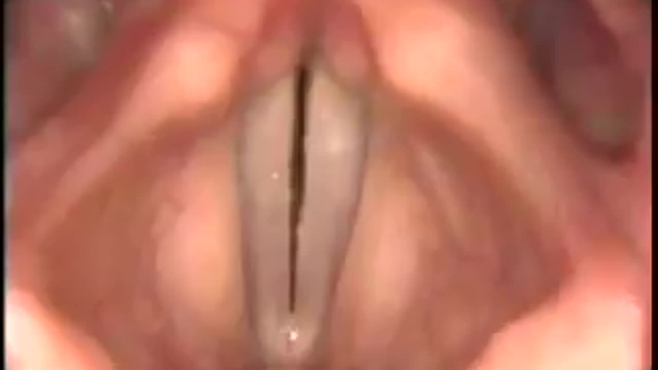 Stroboscopy: Rigid: Female Vocal cords at high and low pitch