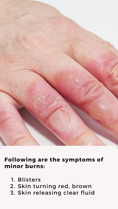 what to do first aid burn skin at home -The Home Doctor book.