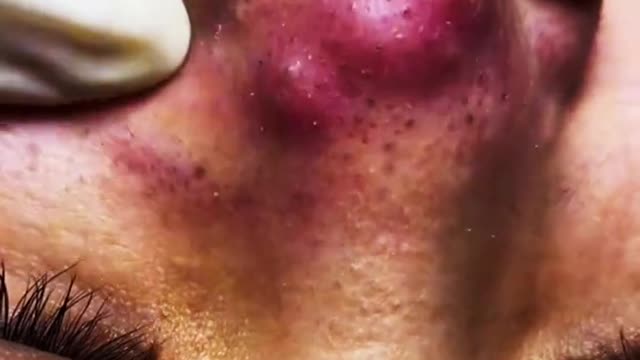 I have a pimple full of pus