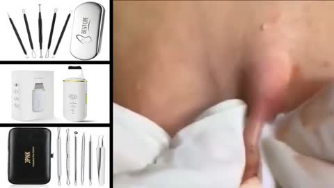 best acne cyst popping 2021!!!