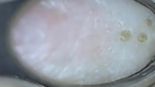 How to remove blackheads from nose, pop pimples, acne treatment #53 #shorts