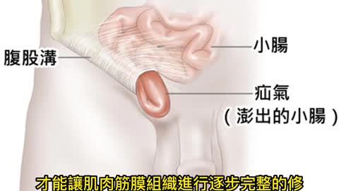 疝氣不處理有生命危險！ 微創手術能雙側修補